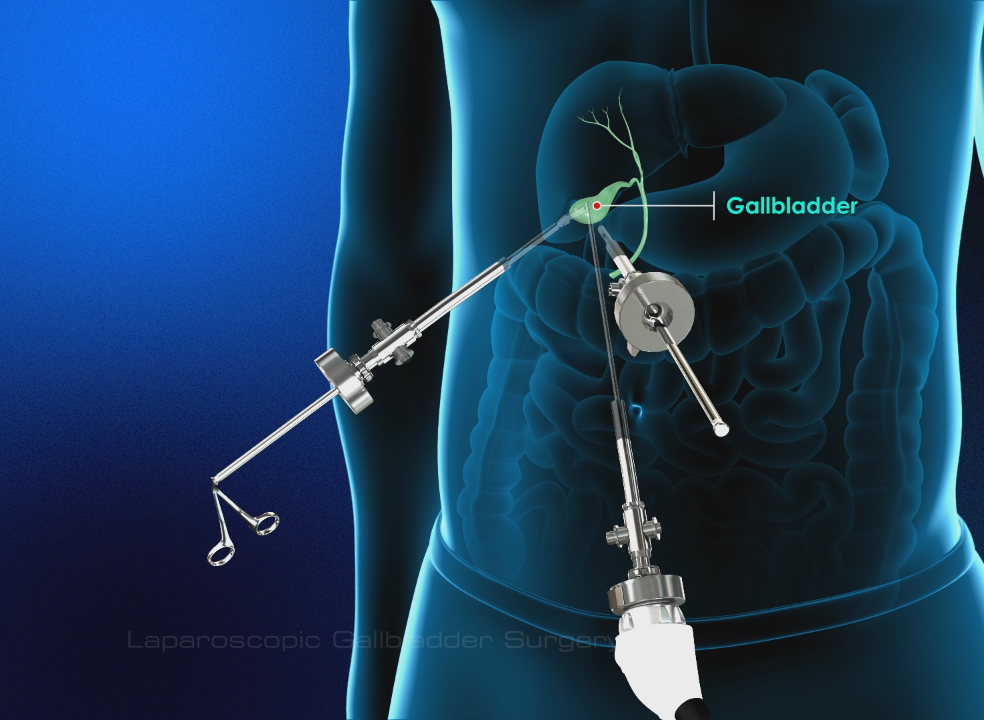 Gallstones Treatment Laparoscopic Surgery